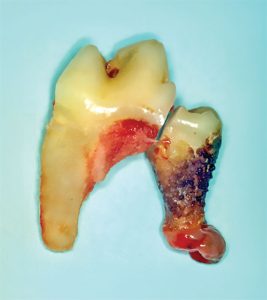 damaged molar
