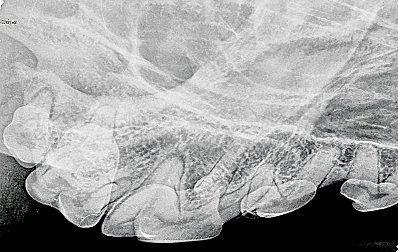 teeth x-ray